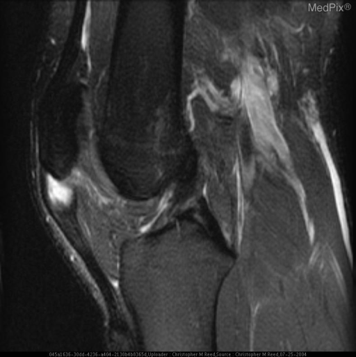 Patellar Tendinosis (Jumper's Knee) with probable partial tear of the patellar tendon.