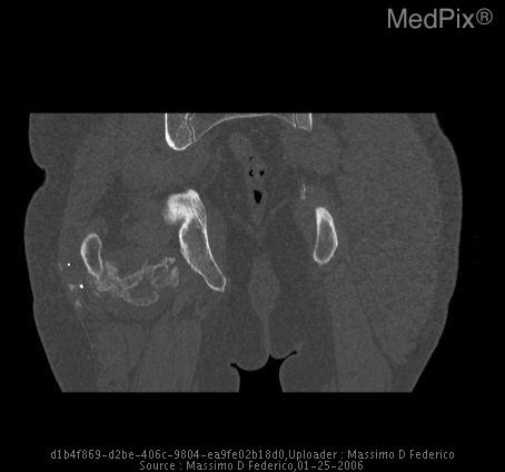 Heterotopic ossification