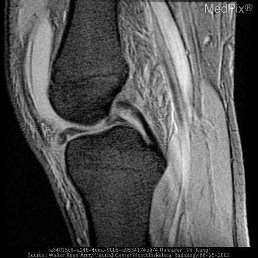 meniscal tear