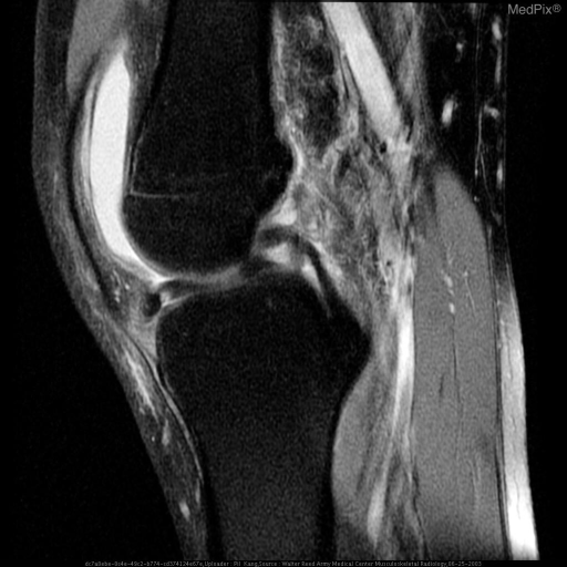 meniscal tear