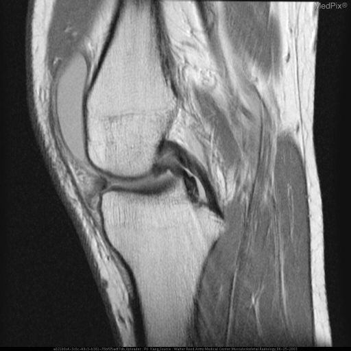 meniscal tear
