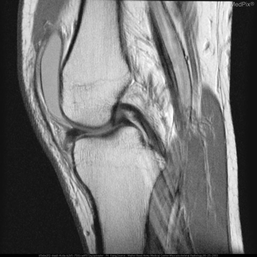 meniscal tear