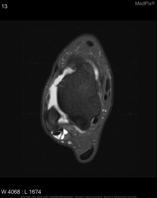 Diagnosis:   Thinning and irregularity of the anterior talofibular ligament consistent with previous inversion injury.