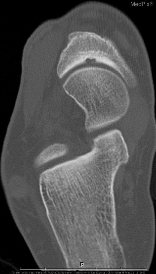 Osteochondritis Dissecans of the Tarsal Navicular