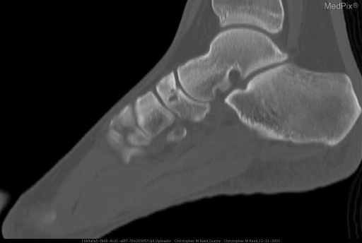 Osteochondritis Dissecans of the Tarsal Navicular