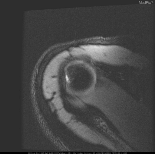 HILL-SACHS DEFORMITY WITH ASSOCIATED BANKART LESION