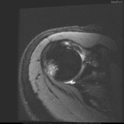 HILL-SACHS DEFORMITY WITH ASSOCIATED BANKART LESION