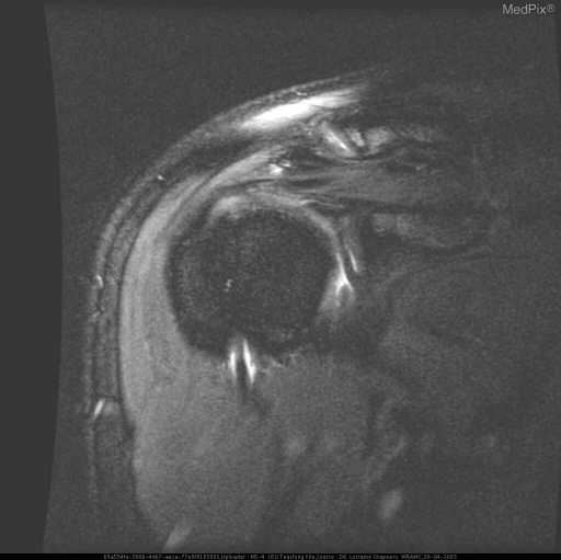 HILL-SACHS DEFORMITY WITH ASSOCIATED BANKART LESION