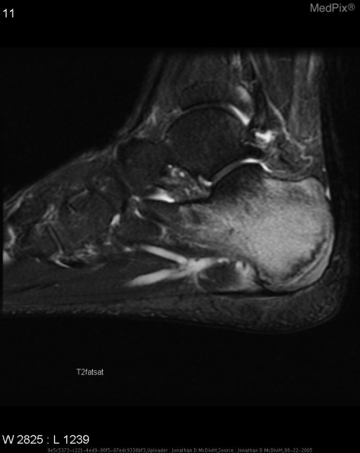 Calcaneal Stress Fracture