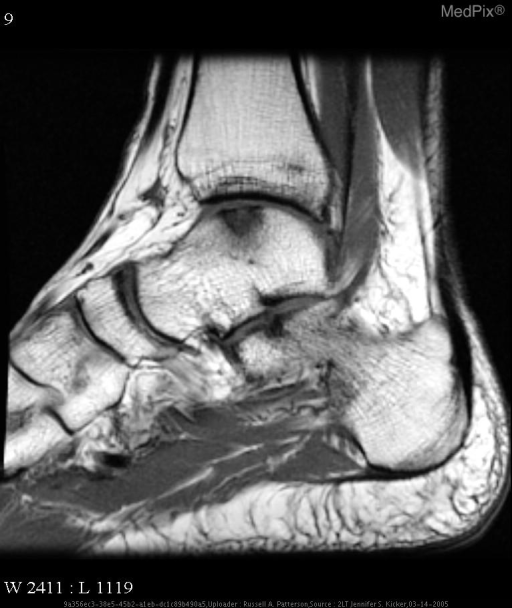 Osteochondritis dissecans.