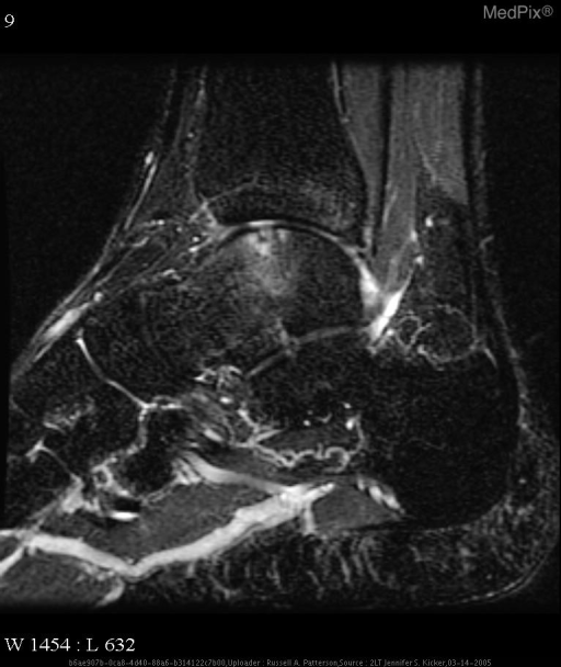 Osteochondritis dissecans.