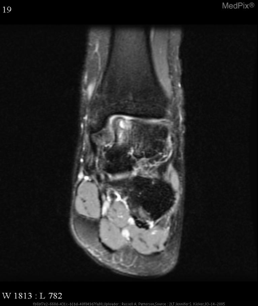 Osteochondritis dissecans.