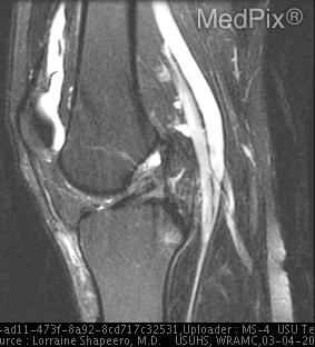 1. Mid-substance anterior cruciate ligament tear.
2. Lateral capsular avulsion consistent with Segond fracture.
3. Partial thickness tear of medial collateral ligament.