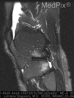 1. Mid-substance anterior cruciate ligament tear.
2. Lateral capsular avulsion consistent with Segond fracture.
3. Partial thickness tear of medial collateral ligament.