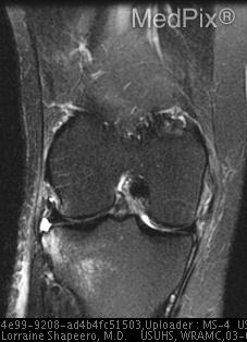 1. Mid-substance anterior cruciate ligament tear.
2. Lateral capsular avulsion consistent with Segond fracture.
3. Partial thickness tear of medial collateral ligament.
