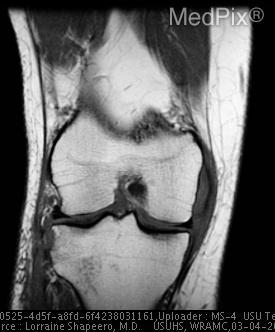 1. Mid-substance anterior cruciate ligament tear.
2. Lateral capsular avulsion consistent with Segond fracture.
3. Partial thickness tear of medial collateral ligament.