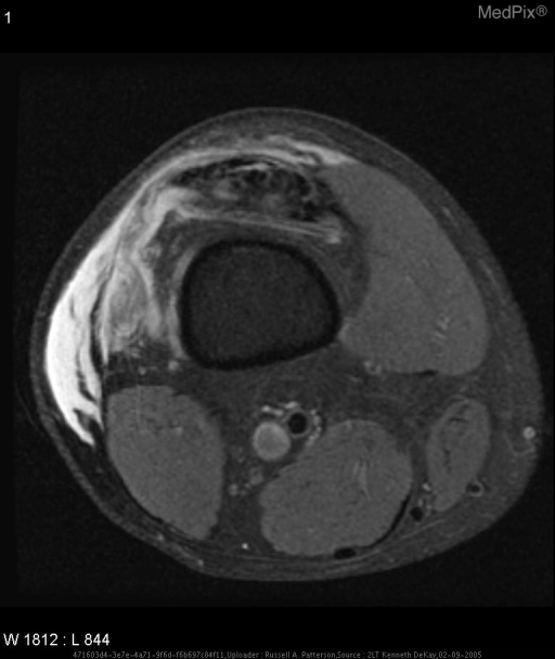 Quadriceps tendon rupture, Medial retinacular tear