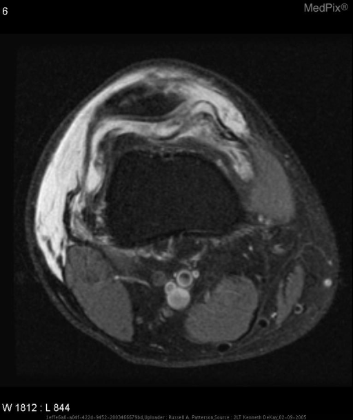 Quadriceps tendon rupture, Medial retinacular tear