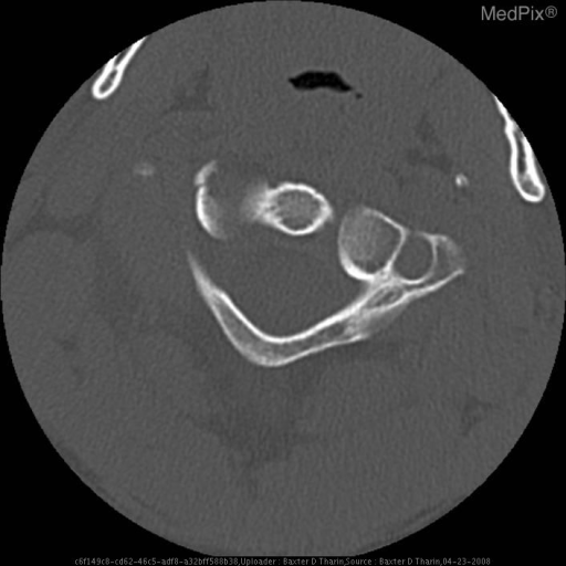 Atlas fracture