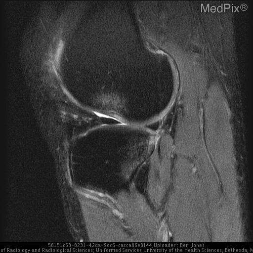 Anterior Cruciate Ligament Disruption
