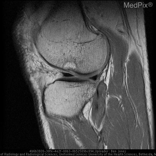 Anterior Cruciate Ligament Disruption