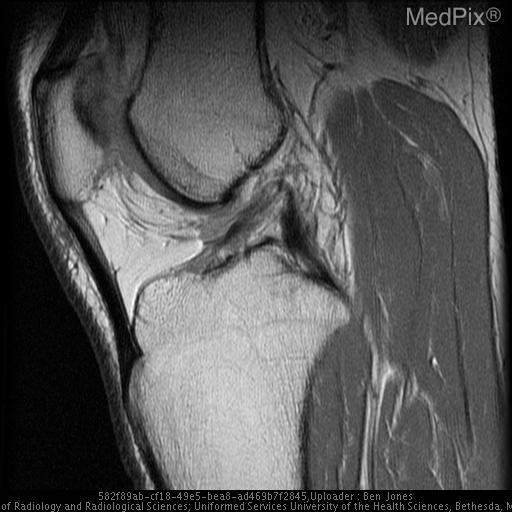 Anterior Cruciate Ligament Disruption