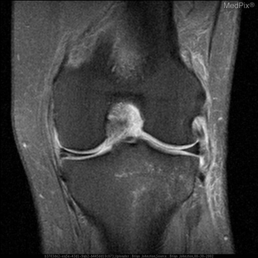 Meniscal Tear (radiologic and athroscopic confirmation)