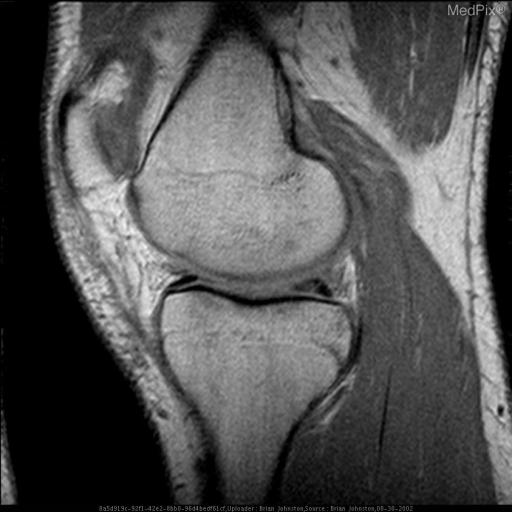Meniscal Tear (radiologic and athroscopic confirmation)