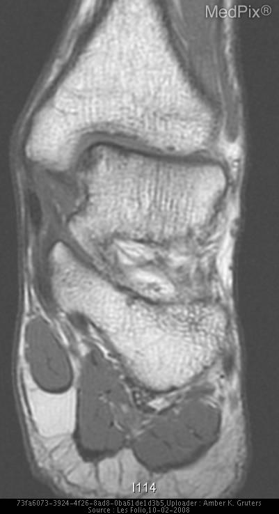 Osteochondritis dissecans