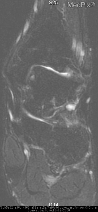 Osteochondritis dissecans