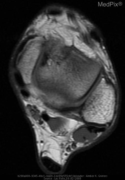 Osteochondritis dissecans
