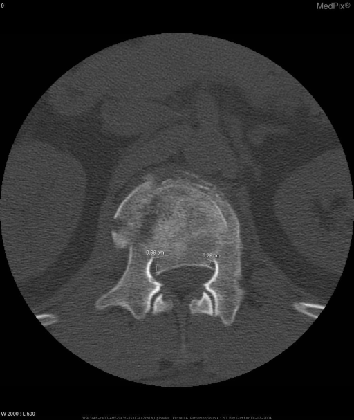 Diagnosis: L1 Burst Fracture.
