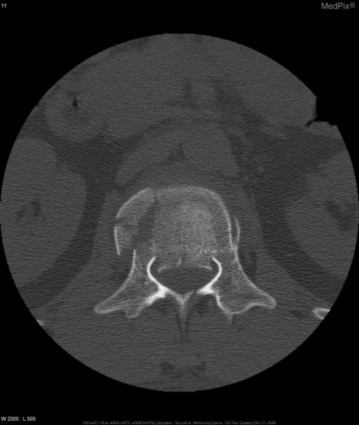 Diagnosis: L1 Burst Fracture.