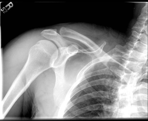 Hill-Sach’s lesion with underlying subcortical bone contusion and subchondral cyst formation consistent with chronicity.