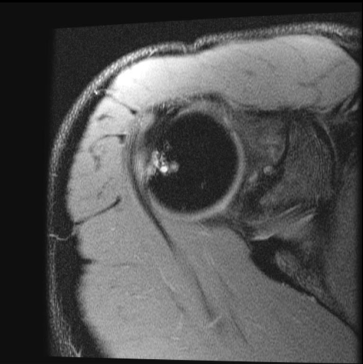 Hill-Sach’s lesion with underlying subcortical bone contusion and subchondral cyst formation consistent with chronicity.