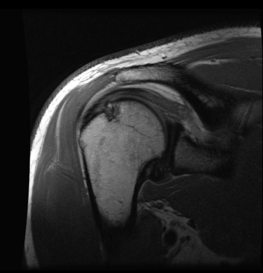 Hill-Sach’s lesion with underlying subcortical bone contusion and subchondral cyst formation consistent with chronicity.