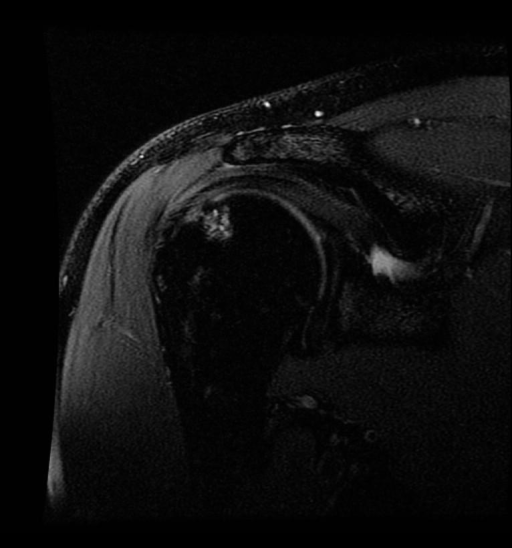 Hill-Sach’s lesion with underlying subcortical bone contusion and subchondral cyst formation consistent with chronicity.