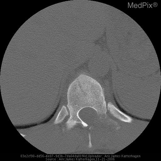 Chance Fracture