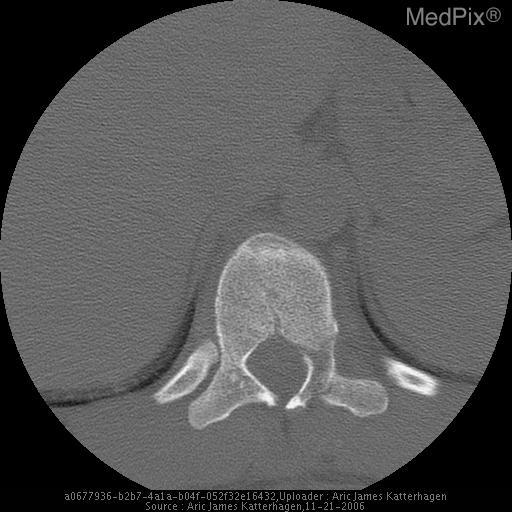 Chance Fracture