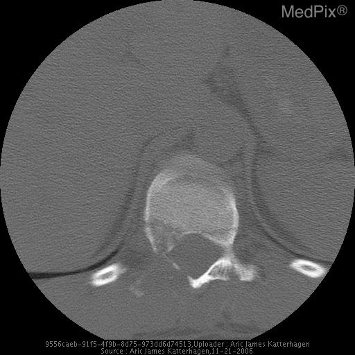 Chance Fracture