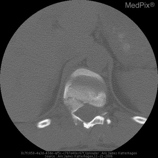 Chance Fracture