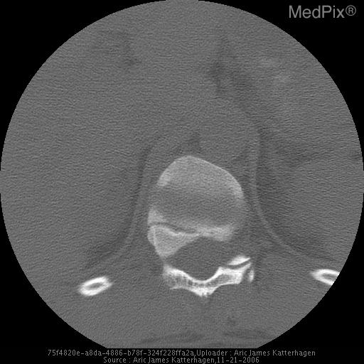 Chance Fracture