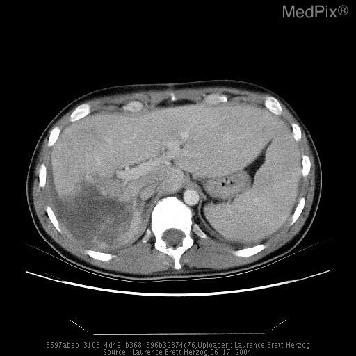 Hepatic laceration with biloma.