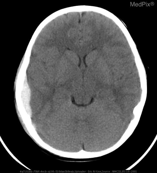 Epidural Hematoma of middle fossa (temporal bone)