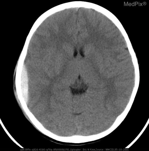 Epidural Hematoma of middle fossa (temporal bone)
