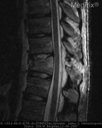 Chance Fracture T11