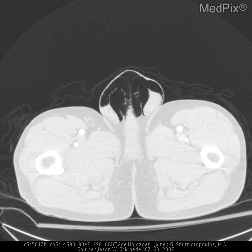 Pneumoscrotum
