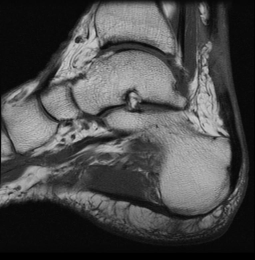 Achilles tendon tear