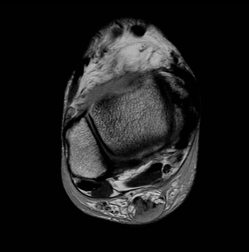 Achilles tendon tear