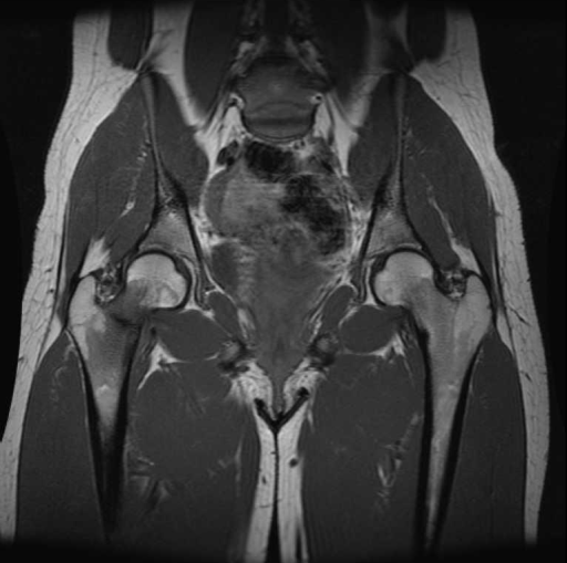 Stress fracture right femoral neck.